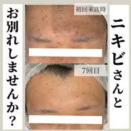 《しつこいニキビをケア  2回コース》スチームフェイシャルマッサージ。鎮静パック付き。