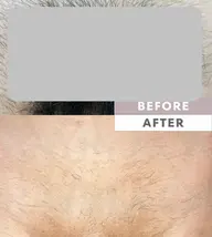 ［仙台メンズ脱毛］  初回　　　VIO脱毛