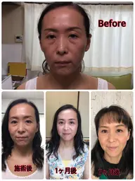 【美肌コース】美肌づくり　ハリ、ツヤ、シワ、リフトアップ、お顔の浮腫も取れ小顔に。