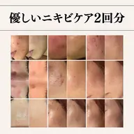 【まずはお試しから】ニキビ/ニキビ跡の炎症に刺激を与えずに集中アプローチ⚡フェイシャルチケット2回分⭐