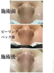 小鼻の毛穴洗浄