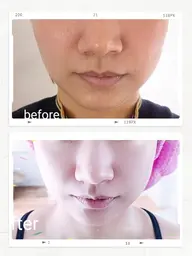 「平日限定」激安❤️お手軽60分毛穴ケア　イチゴ鼻　皮膚ダニ　脂角栓　ダウンタイムなし