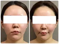 エステ通常価格【ボトックス検討中の方！】改善凝り固まったエラ頬を撃退80分【¥20,900→¥8,800】