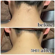 脇、うなじ脱毛