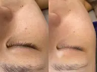 【話題の針美容】ハリツヤ爆誕フェイシャル