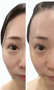 【大人気ご褒美ケア】小顔6step 100分　初回7,500円