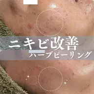 【ニキビ・毛穴改善】剥けないハーブピーリング＋選べる美肌オプション1種＋ipsp幹細胞仕上げ　定価18,150円