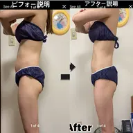 キャビテーション　痩身