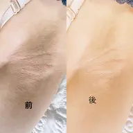脱毛後のワキ美白ケア