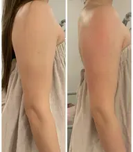 【初回限定】脂肪冷凍　Mカップ２つ