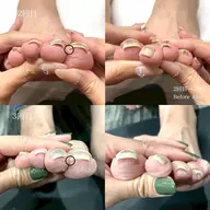 【片親指】💐巻き爪矯正