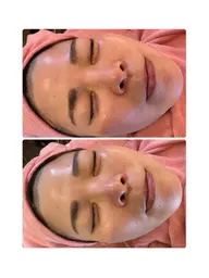 【お得クーポン❣️】毛穴洗浄➕小顔ケア➕保湿ケアでぷるぷる潤い美肌へ✨