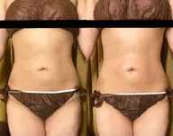 【痩身】当店人気No.1マシン🏅サーモシェイプDeep60分🔥スッキリ美Bodyへ