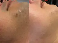 【メンズ髭脱毛】 REVI美肌脱毛