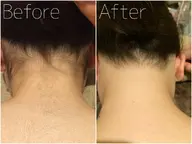 背中脱毛(シェービング込) ￥16,500→￥3,300