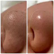 とことん毛穴洗浄！とリラックスエステ