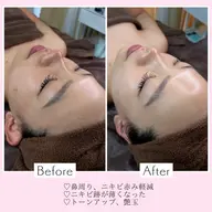 "当日"限定価格‼️ 韓国式美肌毛穴洗浄＆うるツヤ韓国ピーリング(剥離なし)