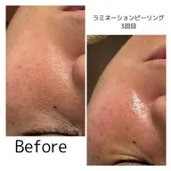 【美肌🌿ラミネーションピーリング】剥離なし・低刺激✨内から輝く水光肌へ。くすみをオフして、潤いと弾力に満ちたツヤ肌体験