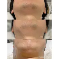 【5回まで特別価格✨】メンズLED髭脱毛