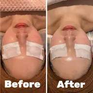 光フォト＋リフトアップマッサージ