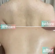 【背中のざらつき✨ポツポツケア】広範囲フル洗浄+角質ケア♡後ろ姿に自信✨つるんとした素肌へ
