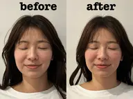 【年齢肌のお悩みに】たるみ・毛穴・ほうれい線　美容鍼（百華鍼）+小顔矯正