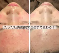 ハーブピーリング🌿全顔【2回目限定】