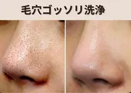 【卒業・入学前にお手軽メンテナンス】当サロン人気No.1🥇ハイドラ毛穴洗浄|黒ずみ皮脂角質すっきり！