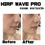 期間限定価格❣️エステ版ソフウェーブ【HIRF WAVE PRO】全顔・顎下・首