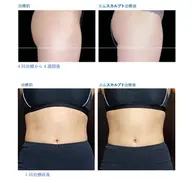 【夏までに痩せたい方必見】次の日には筋肉痛🔥エムスカルプト痩身エステ