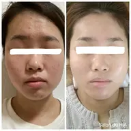 60分🕑️肌質改善🌿日本製ハーブピーリング🌿剥離なし◎ダウンタイムなし◎痛みなし◎即メイクOK◎