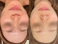 【仕上がり重視】本格毛穴洗浄。ザラつきのないなめらか素肌へ※全顔