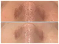 【毛穴・ニキビ集中】REVIハーブピーリングお試し🌿+ヘッドマッサージ付き ¥6,600