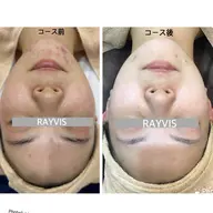 【最新!】フォト×顔脱毛!シェービング付💕毛穴・ニキビ・ニキビ跡・乾燥・シワ・シミ・たるみ・赤みを徹底ケア