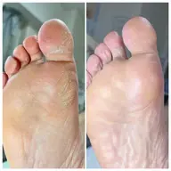 🦶韓国式足裏角質ケア🦶🥳エスプランニング👍🏻❤️古い角質ごっそり取れて赤ちゃんの足裏へ👶