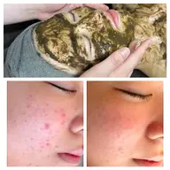 【本気のニキビケア】ハーブピーリング✨100%有効成分のハーブ🌿