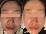 【垢抜けフルコース】うなじ+フェイスワックス✨後ろ姿まで美しく◎