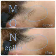 うなじワックス脱毛