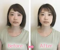 【たるみ・むくみ解消】痛くない小顔矯正✨リフトアップ実感
