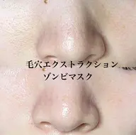 【開き毛穴にはコレ！】毛穴エクストラクション+ゾンビマスク