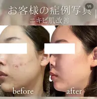 【大人ニキビケア】大人のゆらぎ肌ケア🌷