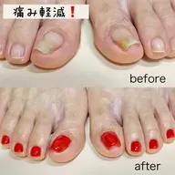 巻き爪補正✨親指2本＋ワンカラー👣オフ有
