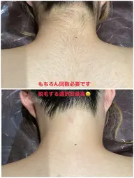 20代限定【全身＋VIO】1番人気🥇全箇所自己処理不要💁🏻‍♀️剃らずに来店ok👌1回¥10000→¥9000