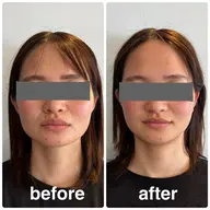 🎁口コミ投稿投稿必須✨小顔矯正+リンパドレナージュ付き(45分) 1000円(税込)