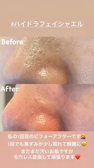 ハイドラフェイシャル