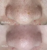 毛穴洗浄 90分 レディースメンズOK👌