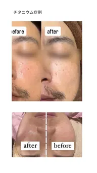 チタニウムリフト(首〜全顔)