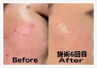 🔶美顔🔶【3つのマシンで深層から毛穴/ニキビケア】毛穴洗浄+イオン導入+ポレーション アクネ菌を抑制します!