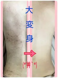 ❇️❇️２回目モニター様🌿剥けるor剥けない選択可能🤩Bodyハーブピーリング🌿期間限定２回目予約の方❇️❇️