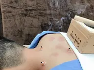 【ミニモ割】鍼灸セット​〜​さまざまな痛みの改善に！​〜​